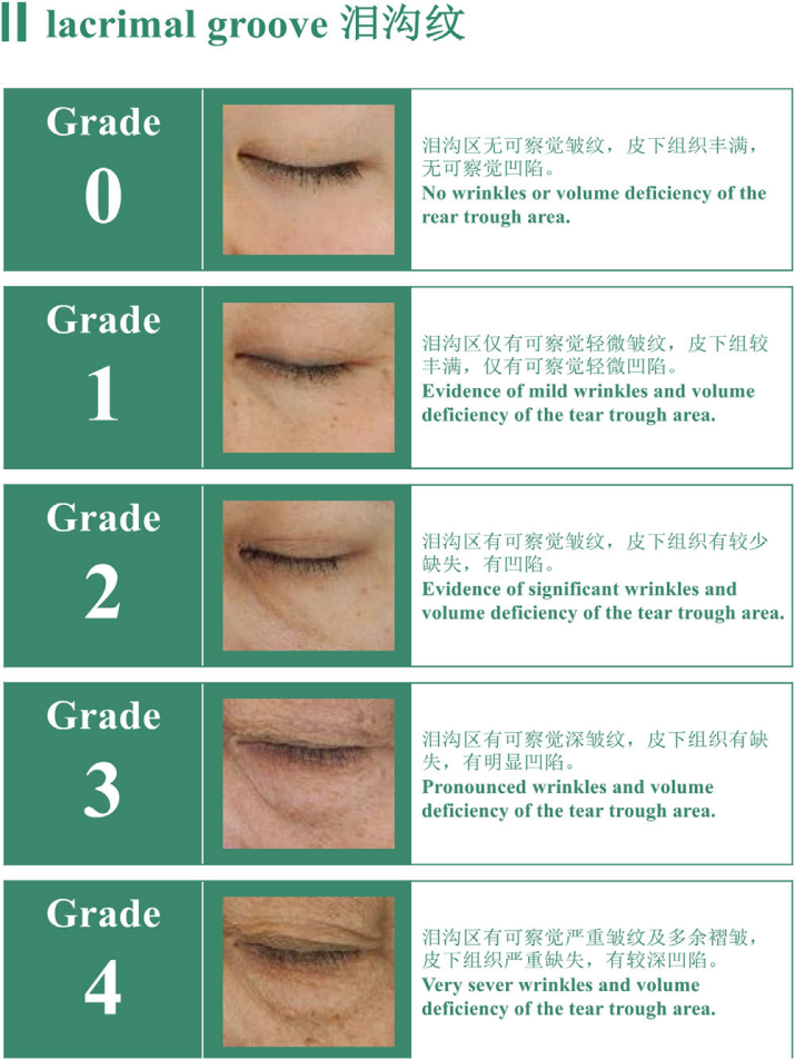 中国女性泪沟纹分级标准-上海市皮肤病医院